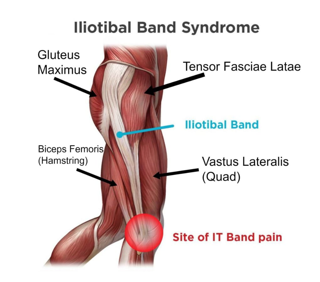 ITBS (Iliotibial Band Syndrome)